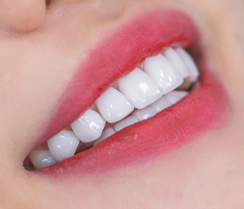 So sánh bọc răng sứ Lava Esthetic, Orodent và Cercon HT